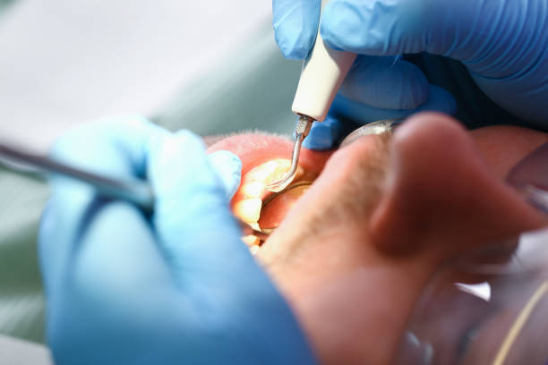 Best Emergency Root Canal Treatment in Minonk, IL